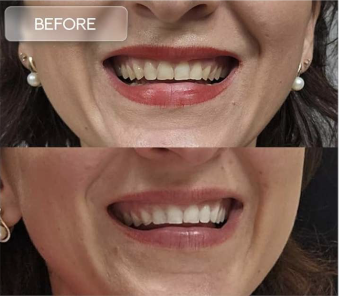 Green Whitening Strips