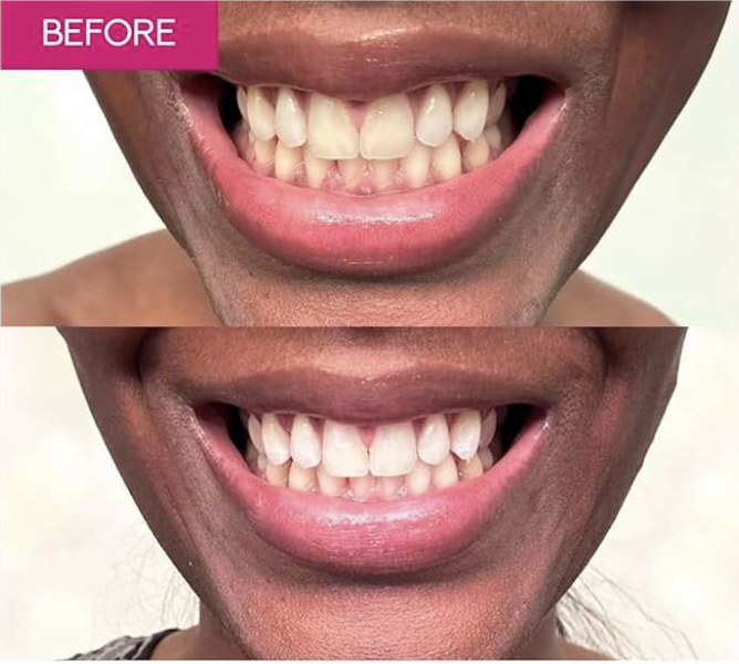 Advanced Whitening Strips